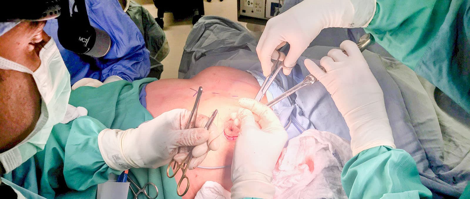 Plastische Chirurgie Bochum: Ihr Spezialist für Bauchdeckenstraffung