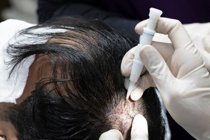 Haartransplantation in istanbul: Ein Blick auf die besten Kliniken und Chirurgen